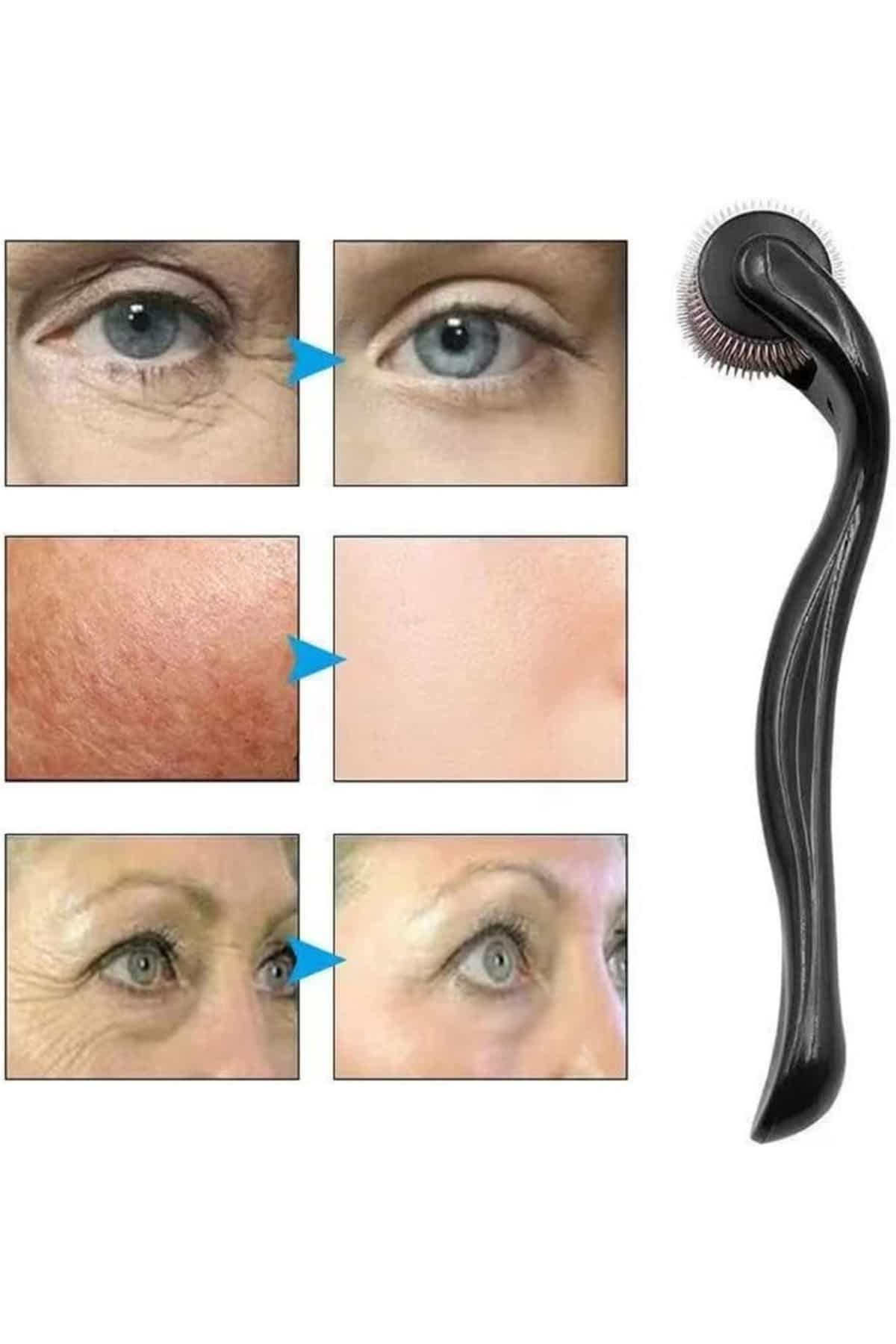 540 adet titanyum iğnesi ile etkili ve güvenli kullanım sunar. Her biri 1 mm uzunluğunda olan bu mikro iğneler