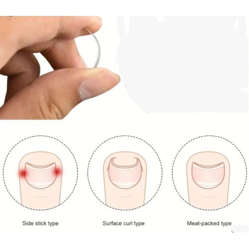 tırnağınızı yavaşça kaldırarak ve düzelterek batık oluşumunu engeller. Evde kolayca uygulayabileceğiniz bu ürünle profesyonel bir sonuç elde edin.Baş parmak tırnak batması için kalıcı bir çözüm arıyorsanız